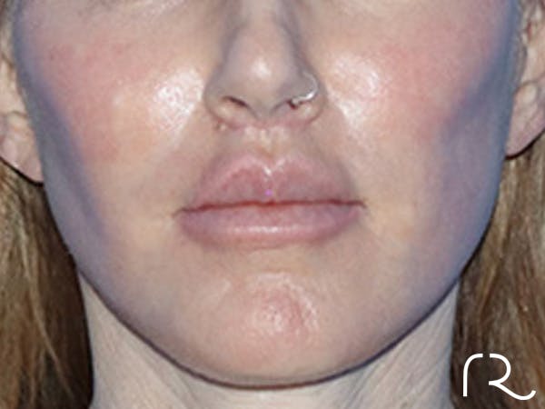 Lip Lift Before & After Gallery - Patient 168494178 - Image 2
