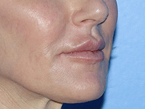 Lip Lift Before & After Gallery - Patient 168494178 - Image 3