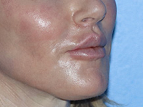 Lip Lift Before & After Gallery - Patient 168494178 - Image 4