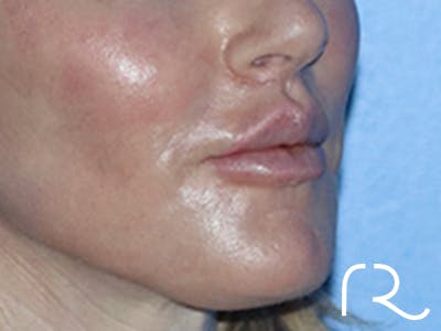 Lip Lift Before & After Gallery - Patient 168494178 - Image 4