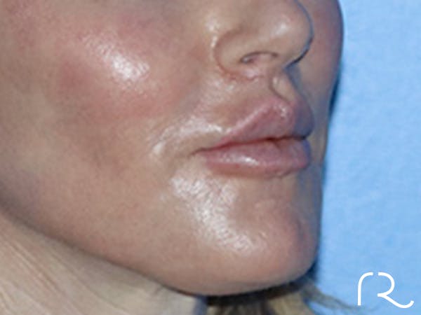 Lip Lift Before & After Gallery - Patient 168494178 - Image 4