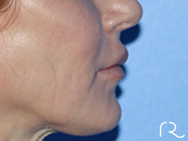 Lip Lift Before & After Gallery - Patient 168494178 - Image 5
