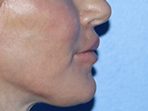 Lip Lift Before & After Gallery - Patient 168494178 - Image 6
