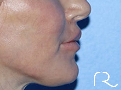 Lip Lift Before & After Gallery - Patient 168494178 - Image 6