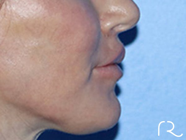 Lip Lift Before & After Gallery - Patient 168494178 - Image 6