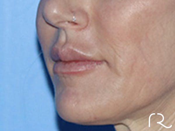 Lip Lift Before & After Gallery - Patient 168494178 - Image 7