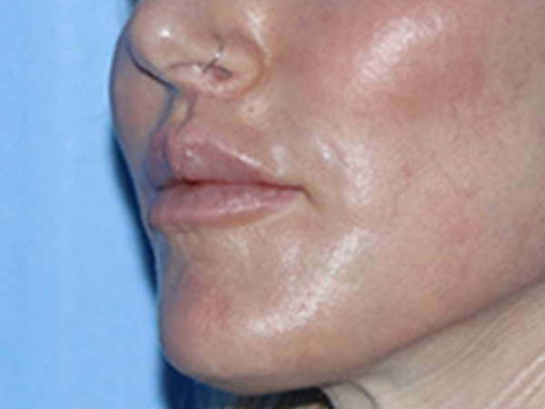 Lip Lift Before & After Gallery - Patient 168494178 - Image 8