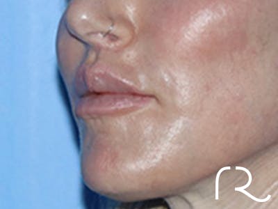 Lip Lift Before & After Gallery - Patient 168494178 - Image 8