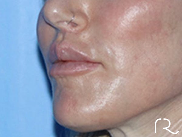 Lip Lift Before & After Gallery - Patient 168494178 - Image 8