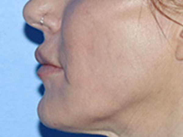 Lip Lift Before & After Gallery - Patient 168494178 - Image 9