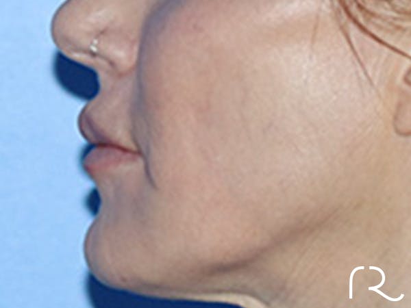 Lip Lift Before & After Gallery - Patient 168494178 - Image 9