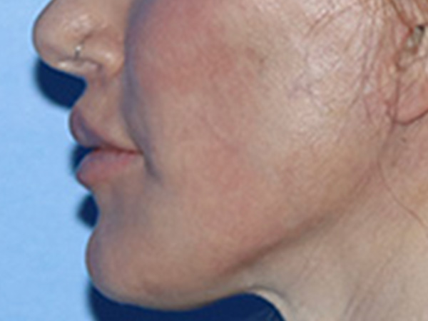 Lip Lift Before & After Gallery - Patient 168494178 - Image 10