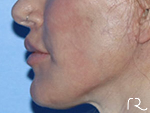 Lip Lift Before & After Gallery - Patient 168494178 - Image 10