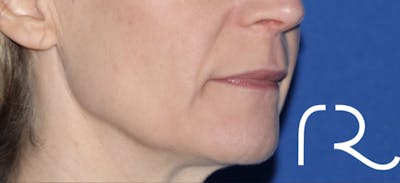 Fractional CO2 Laser Resurfacing Before & After Gallery - Patient 146621397 - Image 2