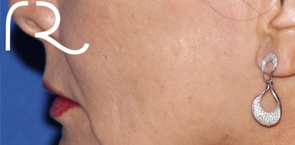 Fractional CO2 Laser Resurfacing Before & After Gallery - Patient 146621399 - Image 1