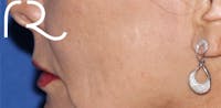 Fractional CO2 Laser Resurfacing Before & After Gallery - Patient 146621399 - Image 1