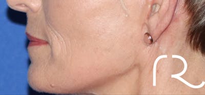 Fractional CO2 Laser Resurfacing Before & After Gallery - Patient 146621398 - Image 2