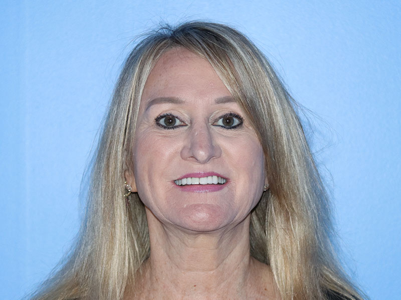 Facelift Before & After Gallery - Patient 177905842 - Image 5