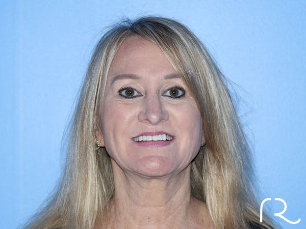 Extended Deep Neck Lift Before & After Gallery - Patient 177905970 - Image 5