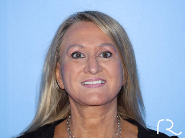 Facelift Before & After Gallery - Patient 177905842 - Image 6