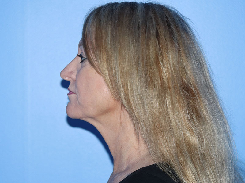 Facelift Before & After Gallery - Patient 177905842 - Image 9