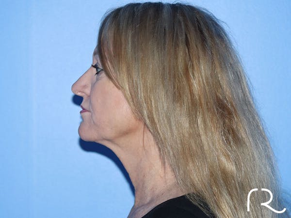 Extended Deep Neck Lift Before & After Gallery - Patient 177905970 - Image 9