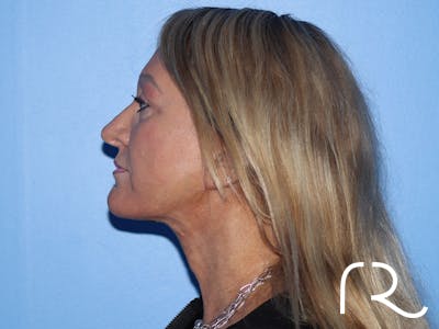 Facelift Before & After Gallery - Patient 177905842 - Image 10