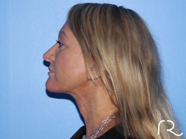 Extended Deep Neck Lift Before & After Gallery - Patient 177905970 - Image 10