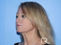 Facelift Before & After Gallery - Patient 177905842 - Image 1