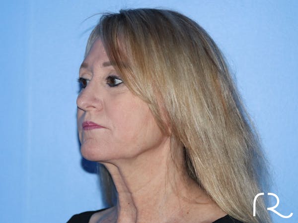 Facelift Before & After Gallery - Patient 177905842 - Image 1