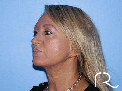 Facelift Before & After Gallery - Patient 177905842 - Image 2