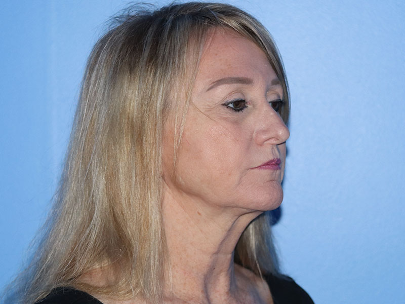 Facelift Before & After Gallery - Patient 177905842 - Image 3