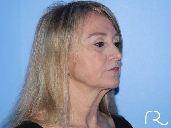 Facelift Before & After Gallery - Patient 177905842 - Image 3