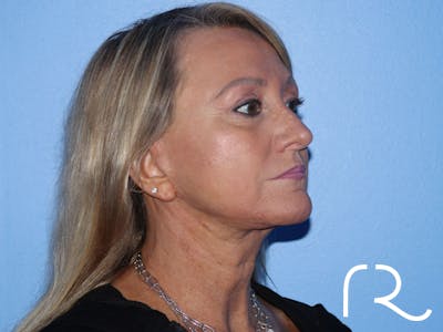 Facelift Before & After Gallery - Patient 177905842 - Image 4