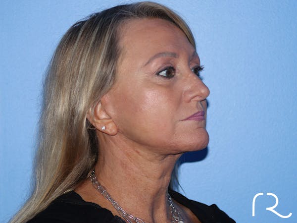 Facelift Before & After Gallery - Patient 177905842 - Image 4