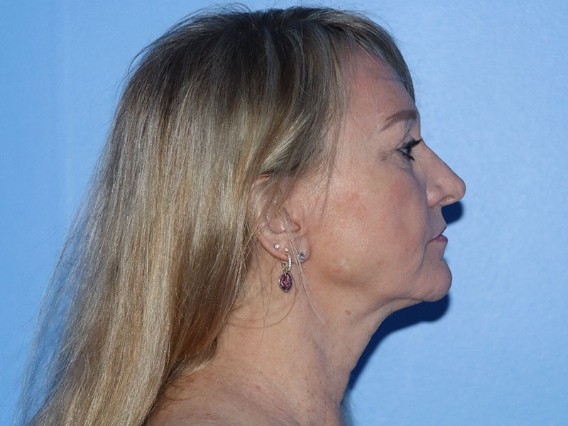 Facelift Before & After Gallery - Patient 177905842 - Image 11