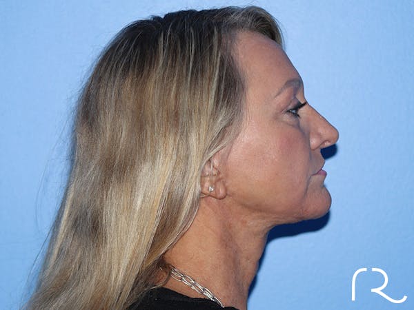 Extended Deep Neck Lift Before & After Gallery - Patient 177905970 - Image 12