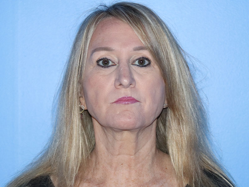 Facelift Before & After Gallery - Patient 177905842 - Image 7