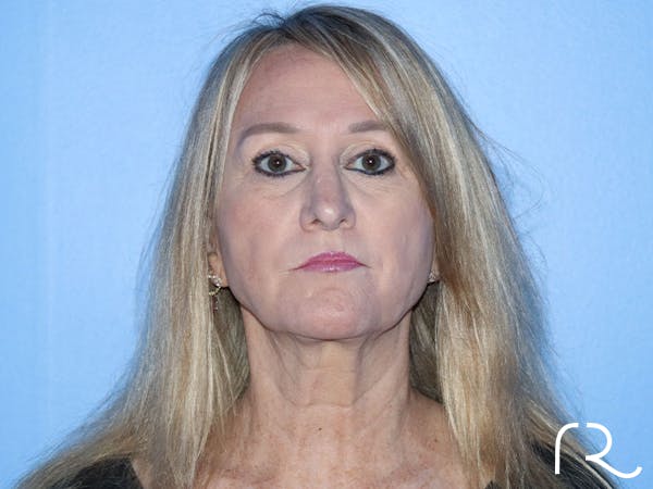 Facelift Before & After Gallery - Patient 177905842 - Image 7