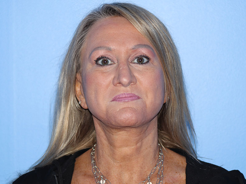 Facelift Before & After Gallery - Patient 177905842 - Image 8