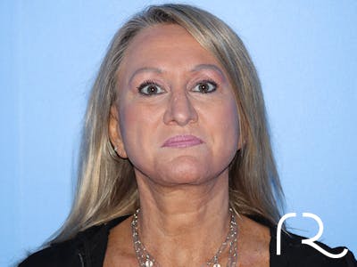 Facelift Before & After Gallery - Patient 177905842 - Image 8