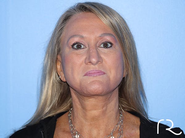 Facelift Before & After Gallery - Patient 177905842 - Image 8