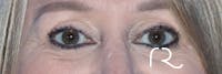 Eyelid Surgery Before & After Gallery - Patient 177905314 - Image 1
