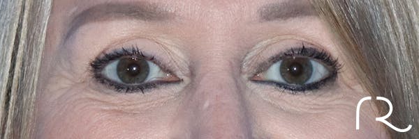 Eyelid Surgery Before & After Gallery - Patient 177905314 - Image 1
