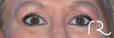 Eyelid Surgery Before & After Gallery - Patient 177905314 - Image 2