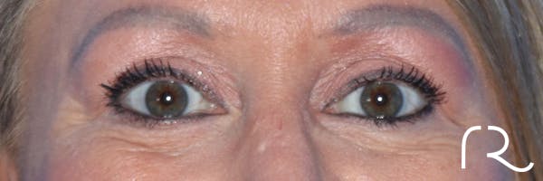Eyelid Surgery Before & After Gallery - Patient 177905314 - Image 2