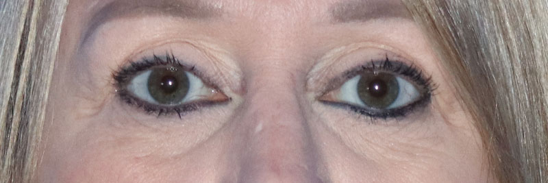 Eyelid Surgery Before & After Gallery - Patient 177905314 - Image 3