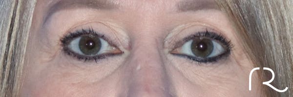 Eyelid Surgery Before & After Gallery - Patient 177905314 - Image 3