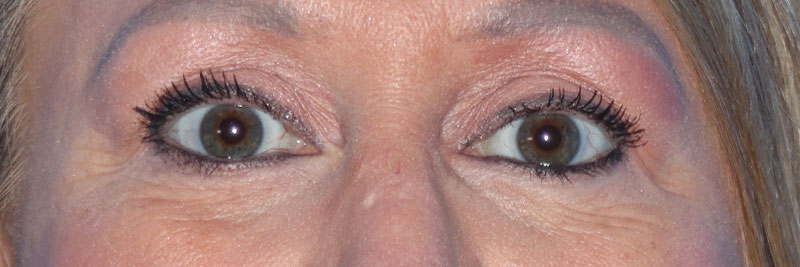 Eyelid Surgery Before & After Gallery - Patient 177905314 - Image 4