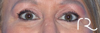 Eyelid Surgery Before & After Gallery - Patient 177905314 - Image 4